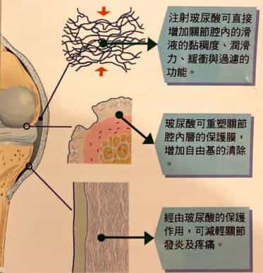 注射玻尿酸對關節內部各部分產生的治療作用