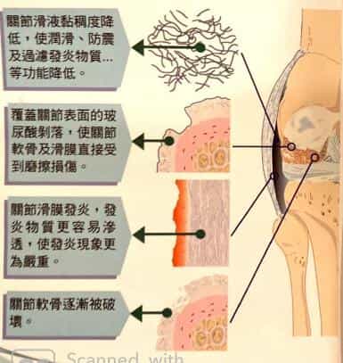 關節缺乏玻尿酸對關節內部結構傷害圖